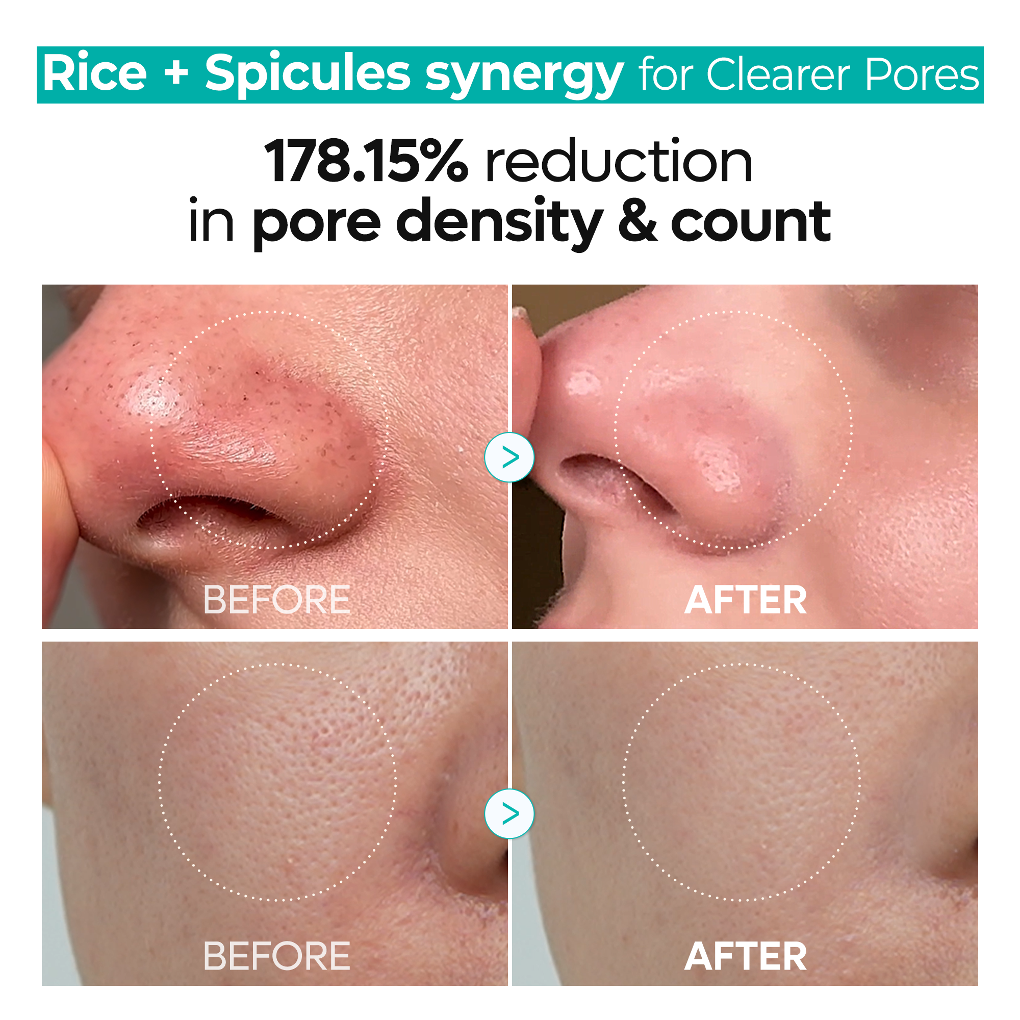 Pore clear & Refine Set