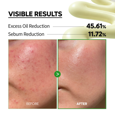 S-ZINC Blemish Cream