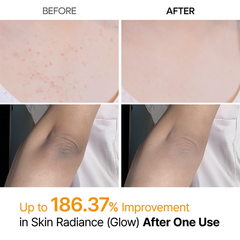[Bumpy, Rough Skin? One Spray Fixes It] Peel Shot – 99% Kojic Acid x Turmeric Body Peeling Spray