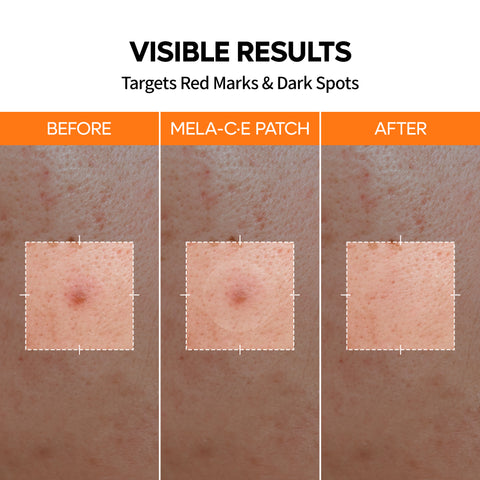 Zero Fit Blemish & Dark Spot Patch Duo