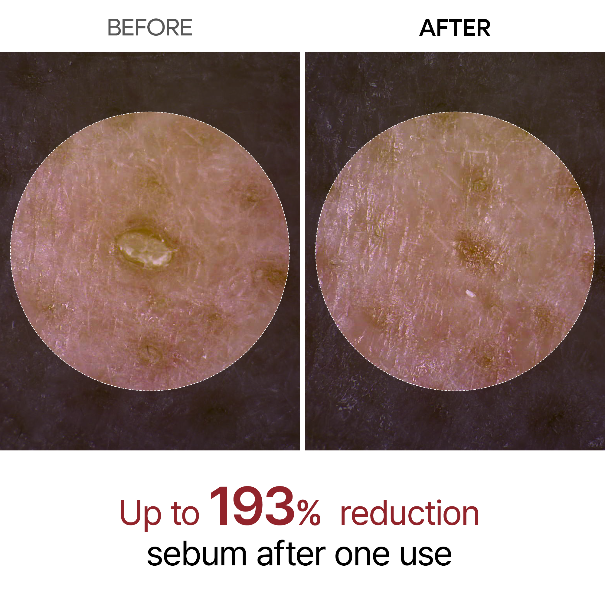 Before After Sebum Reduction